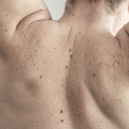 Back of person with freckles and skin discoloration to illustrate laser skin procedures 