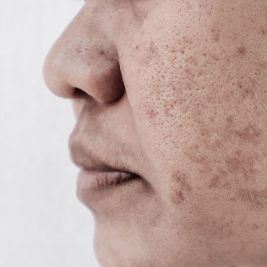 Patient with acne scarring receiving laser skin procedure laser genesis