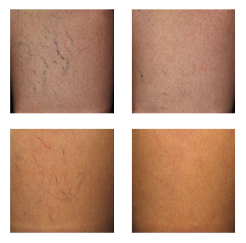 Vein Treatments Before and After Photo
