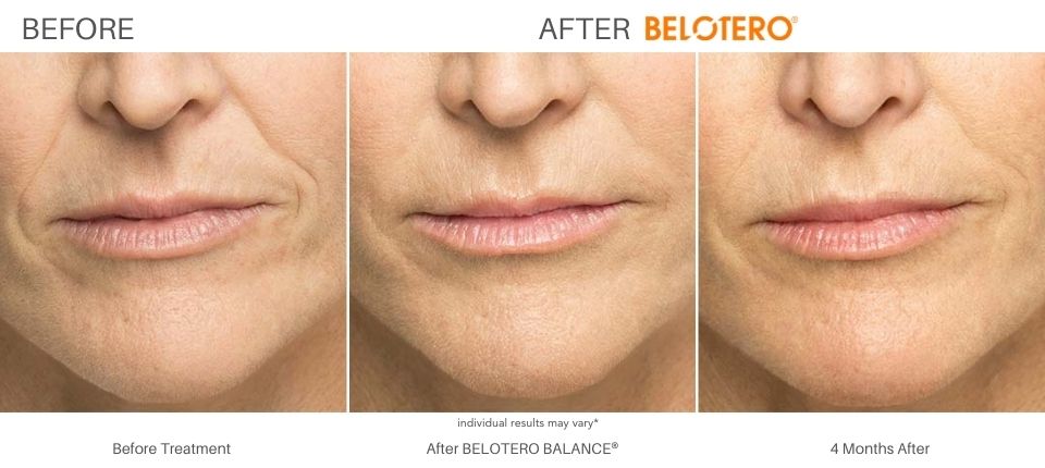 Belotero Before and After