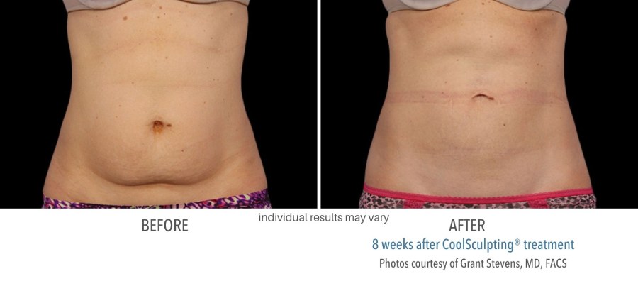 CoolSculpting Before and After Image