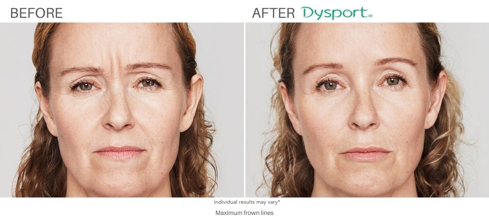 Dysport Before and After