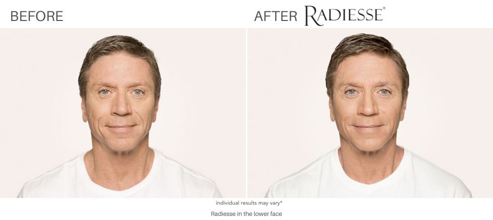 Radiesse Before and After