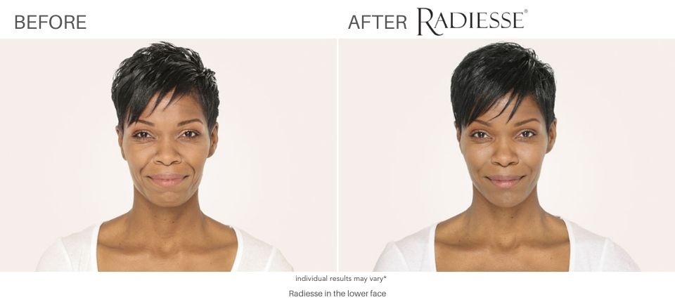 Radiesse Before and After