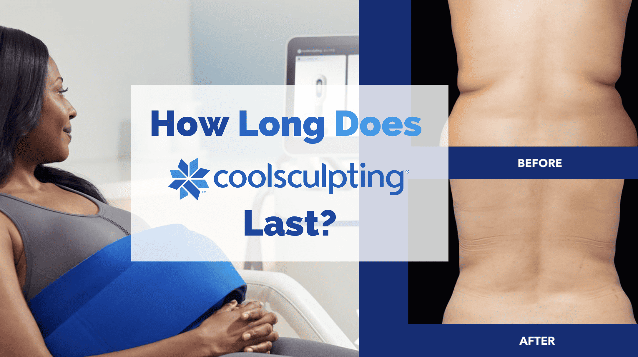 How Long Does CoolSculpting Last? with woman getting CoolSculpting and before/after pictures of the treatment